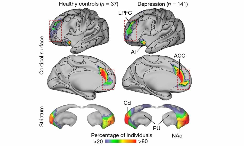 افسردگی و شبکه مغز بزرگ تر