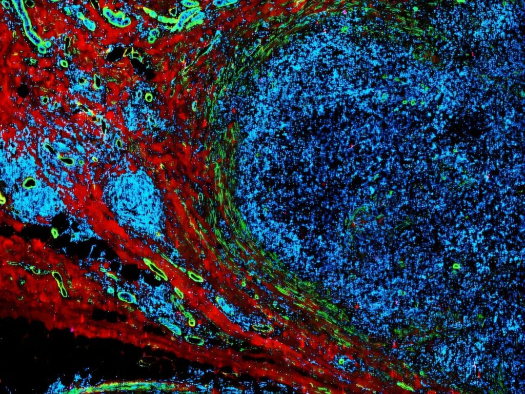 مبارزه با سرطان با پالس‌های الکتریکی با شدت کم