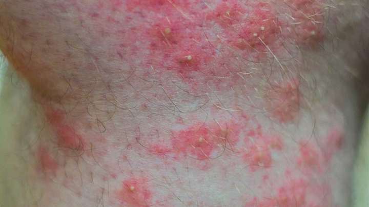 نیش مورچه‌های آتشین