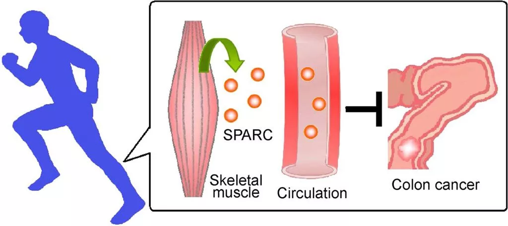 پژوهشگران: ورزش مداوم می‌تواند خطر مرگ مبتلایان سرطان روده را تا ۳۷ درصد کاهش دهد