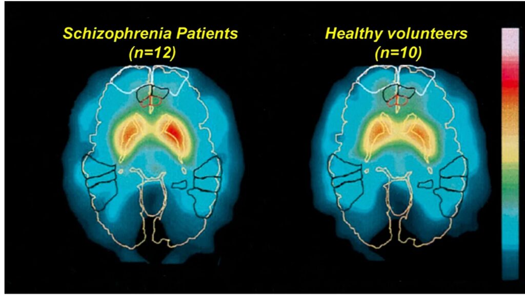 نخستین ابزار تشخیص اسکیزوفرنی با هوش مصنوعی در تایوان معارفه شد_به رنگ صبح 1 تشخیص دقیق اسکیزوفرنی با هوش مصنوعی BrainProbe در تایوان