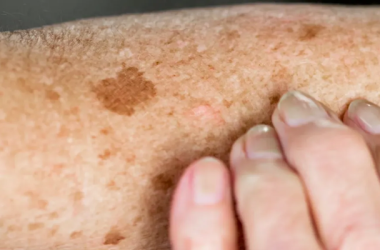 لکه های قهوه ای روی پا