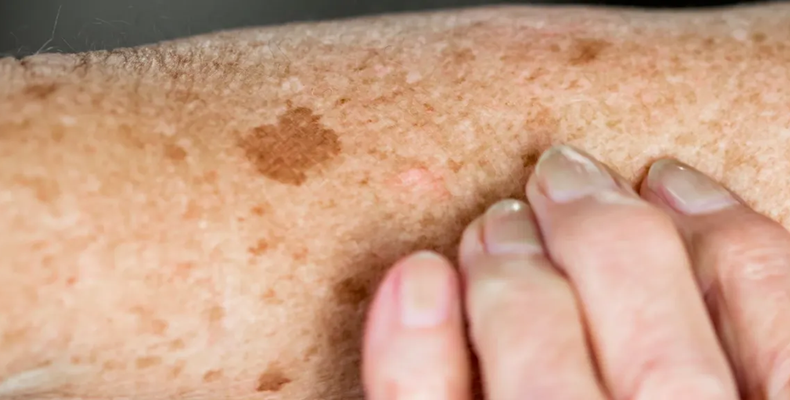 لکه های قهوه ای روی پا